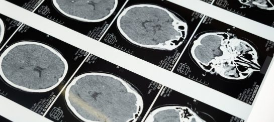 The Latest Developments in Traumatic Brain Injury Law: What You Need to Know
